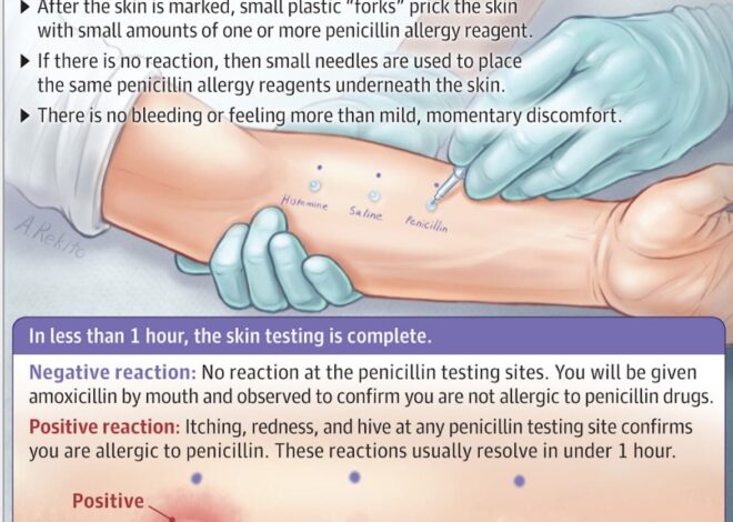 Decoding Penicillin Allergy Testing: Why Europe and America Skip Skin Tests