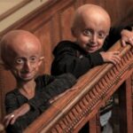 Understanding Progeria: The Journey of an 11-Year-Old Aging Like an 80-Year-Old