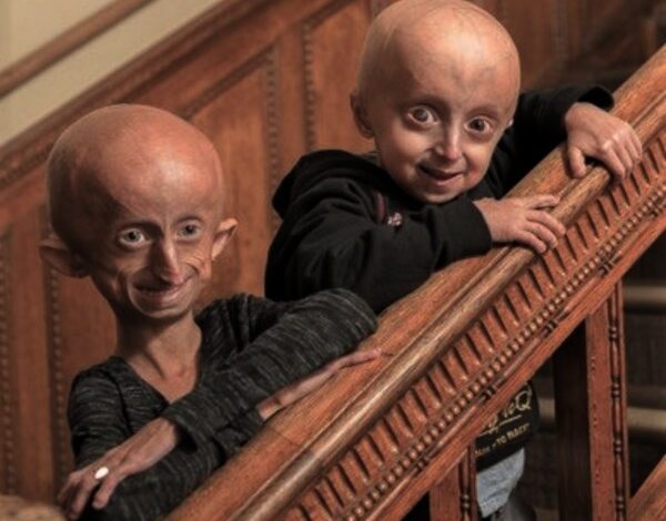 Understanding Progeria: The Journey of an 11-Year-Old Aging Like an 80-Year-Old